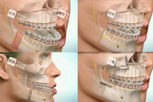 双鄂手术卡通图 双鄂手术卡通图