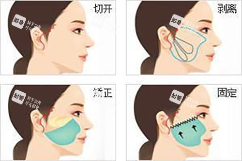 面部耳际小切口拉皮示意图