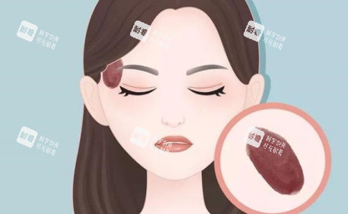 脸上胎记示意图