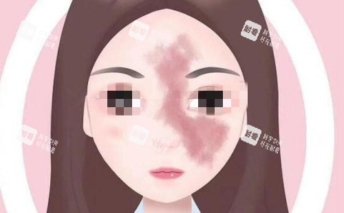 面部胎记示意图