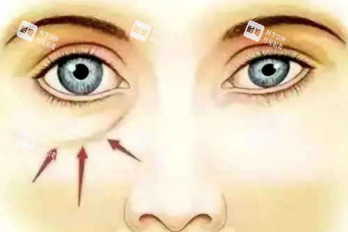 泪沟卡通展示图