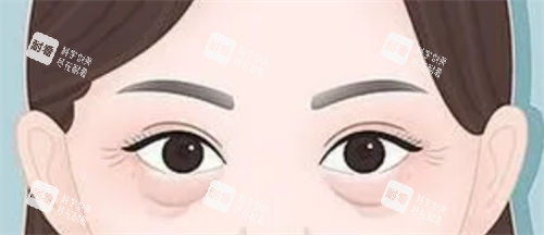 眼袋松弛和泪沟细纹展示图