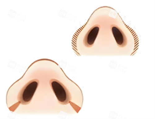 鼻翼缩小手术前后对比图