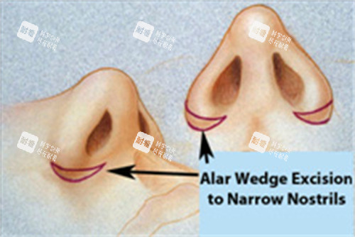 鼻翼缩小对比图