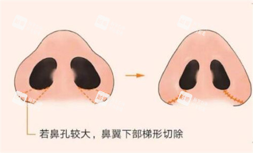 鼻翼缩小手术操作