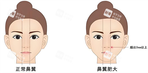 鼻翼缩小异常图