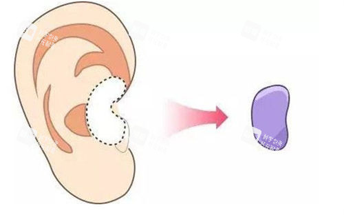 耳软骨隆鼻移除位置展示图