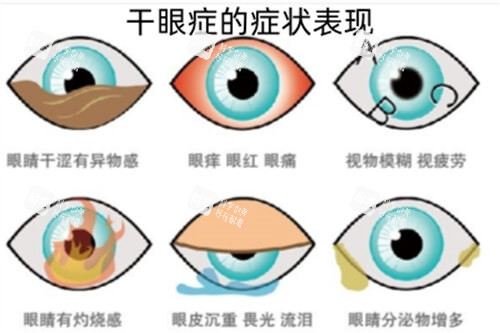 干眼症的症状及表现