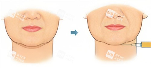 双下巴注射示图