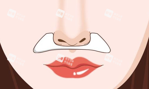 玻尿酸鼻基底填充部位展示