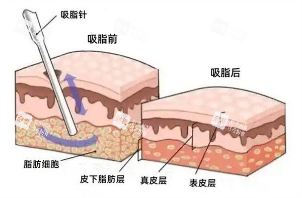 面部吸脂图
