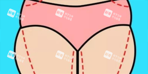 大腿吸脂术前画线展示图