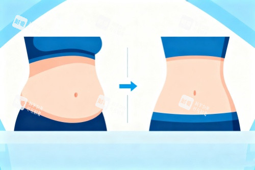 腰腹部做吸脂卡通图