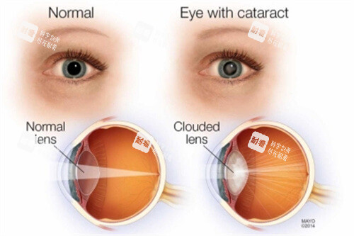正常眼结构与白内障眼结构对比 正常眼结构与白内障眼结构对比