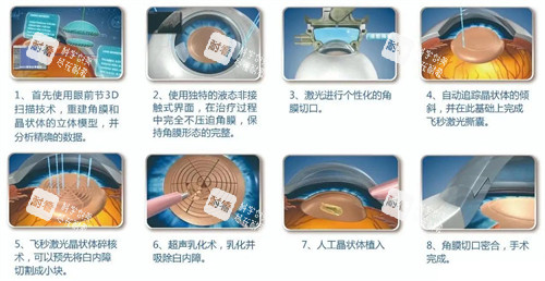 超声乳化白内障手术细节