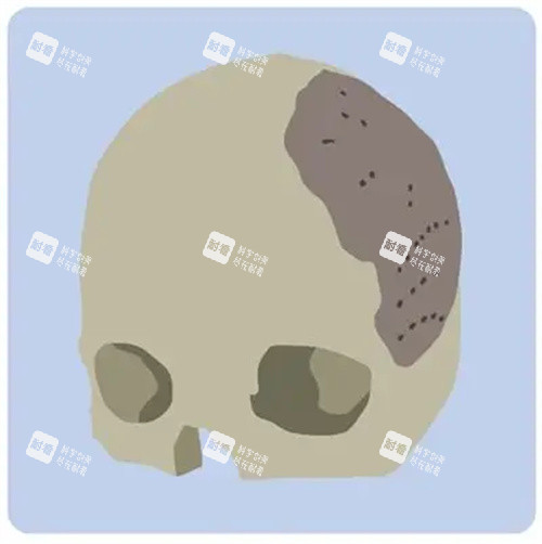 颅骨修复的对比动画图