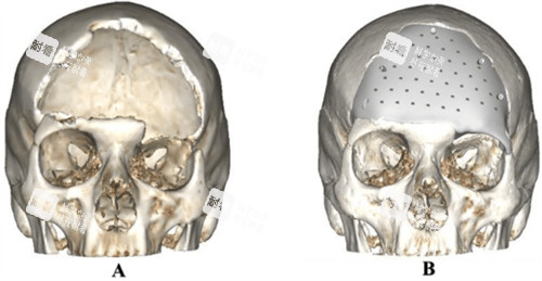 颅骨修补前后对比