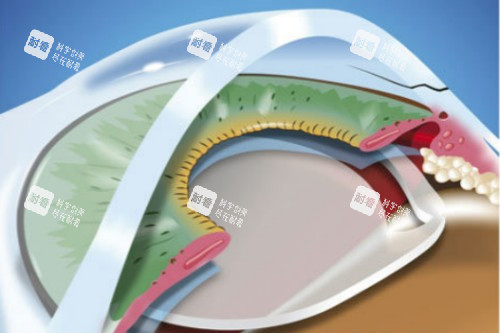 放入白内障晶体 放入白内障晶体