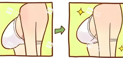 乳房下垂内衣穿着对比