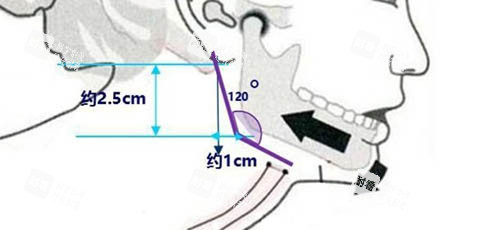 下颌角手术角度设计图