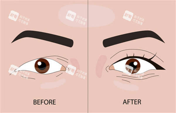 埋线双眼皮整形 埋线双眼皮整形