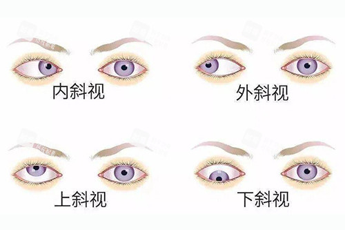 眼睛斜视不同类型分享