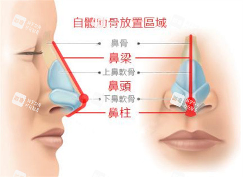 鼻部整形示意图