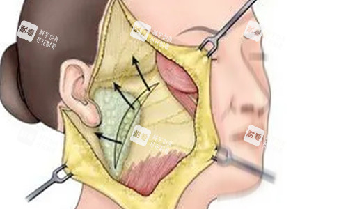 拉皮手术剖开动画示意图 拉皮手术剖开动画示意图
