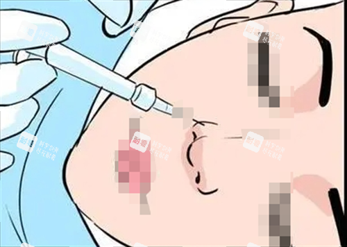 玻尿酸注射鼻子动画展示