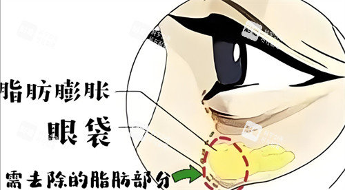 脂肪膨胀性眼袋需要去除的部分 脂肪膨胀性眼袋需要去除的部分