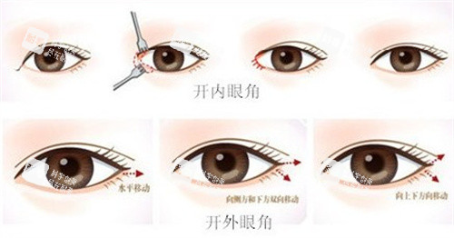 开眼角手术过程图
