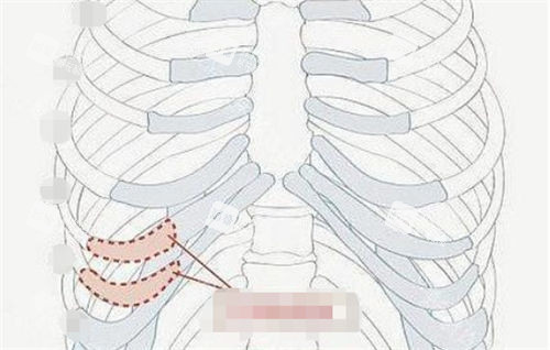 肋软骨隆鼻肋部位置展示图