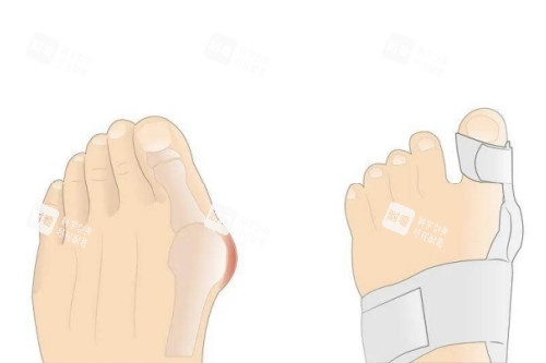 大脚骨矫正卡通图 大脚骨矫正卡通图