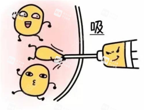 吸脂手术动画 吸脂手术动画
