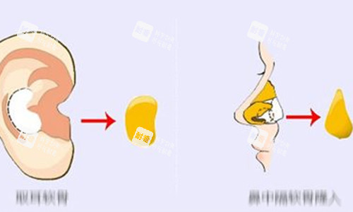 耳软骨隆鼻动画示意图 耳软骨隆鼻动画示意图