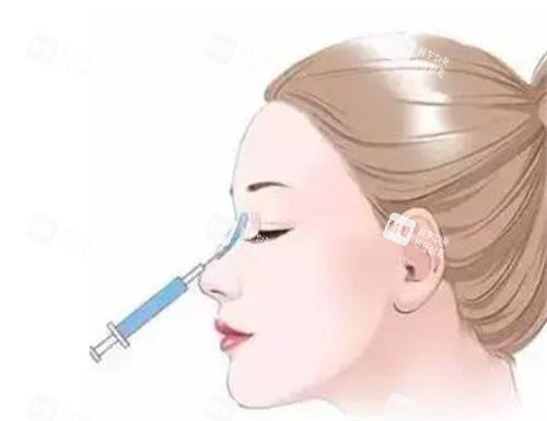 液态隆鼻的部位 液态隆鼻的部位