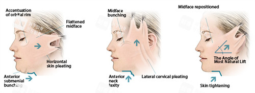 面部提升手术三种提升方向