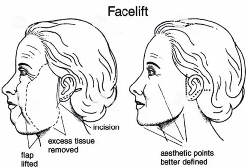 面部提升改善皮肤下垂等问题