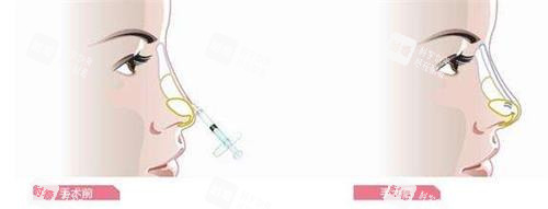 宝尼达玻尿酸打鼻子前后 宝尼达玻尿酸打鼻子前后
