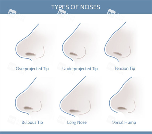 不同形态的鼻子 不同形态的鼻子