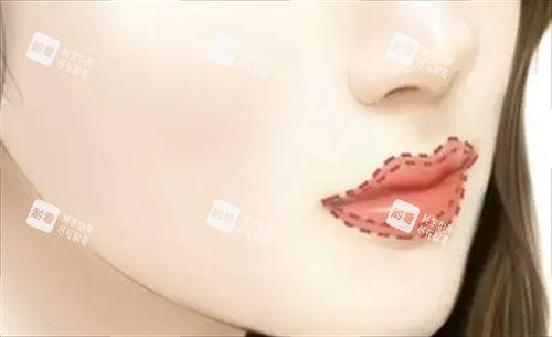 丰唇唇部画线填充图