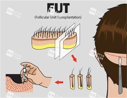 FUT植发技术手术过程图解