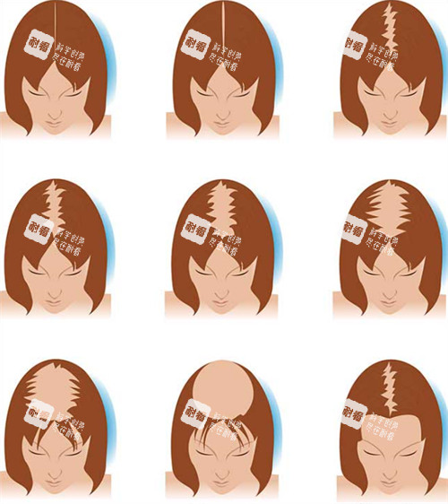 不同情况的毛发缺失