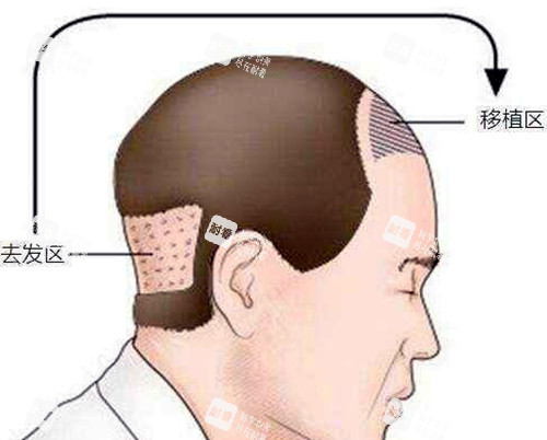 毛发移植图示