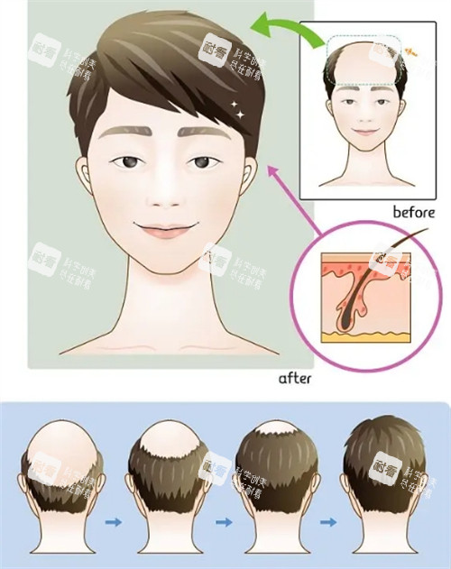 毛发种植手术前后对比