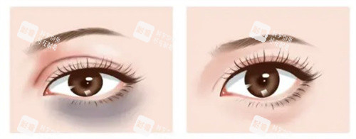 激光去黑眼圈对比 激光去黑眼圈对比