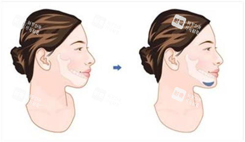垫下巴前后对比