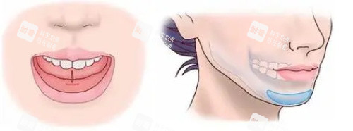 假体垫下巴的位置