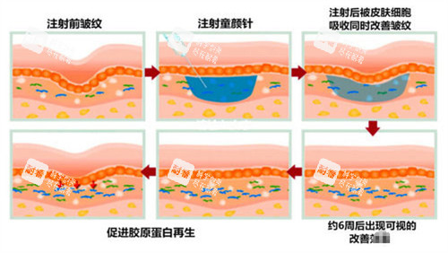 注射童颜针皮肤前后对比图