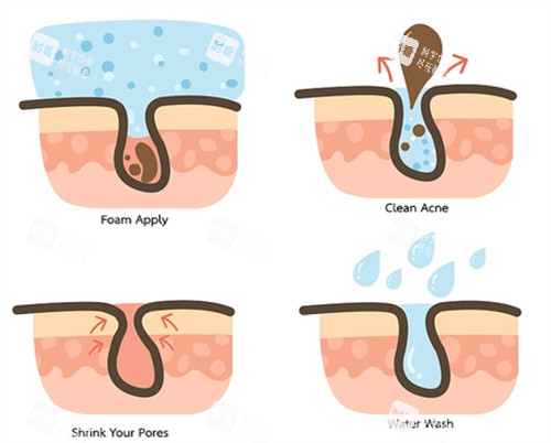 不同的毛孔问题